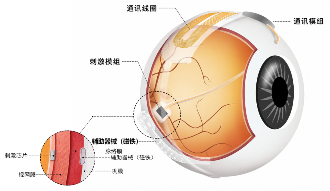 20260901141228861279.png 手术示意图.png